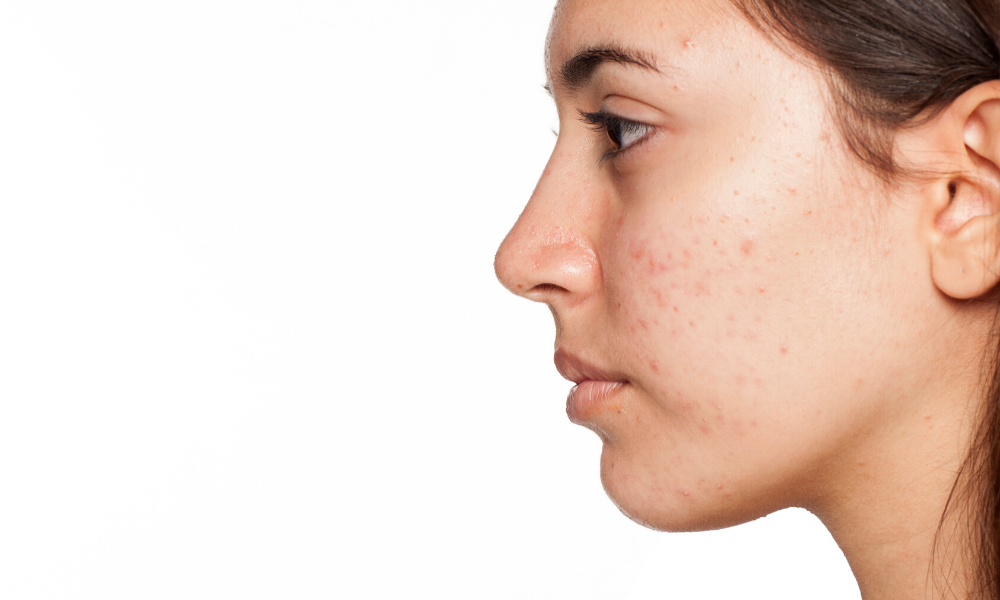 Acne Awareness Month, What Is Acne?