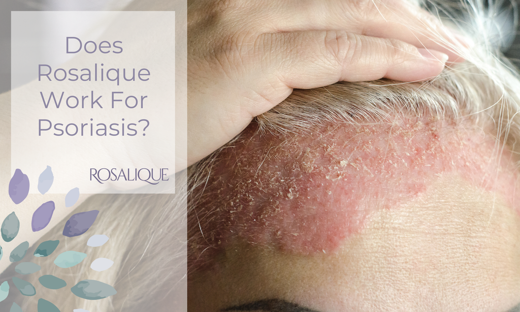 Does Rosalique work for psoriasis?