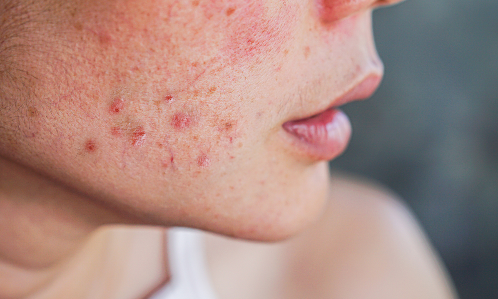 The Ins and Outs of Acne Rosacea