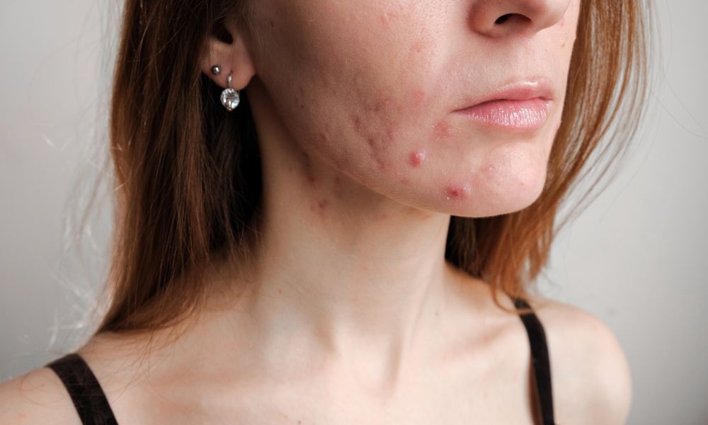 Five Makeup Tips for Acne Sufferers